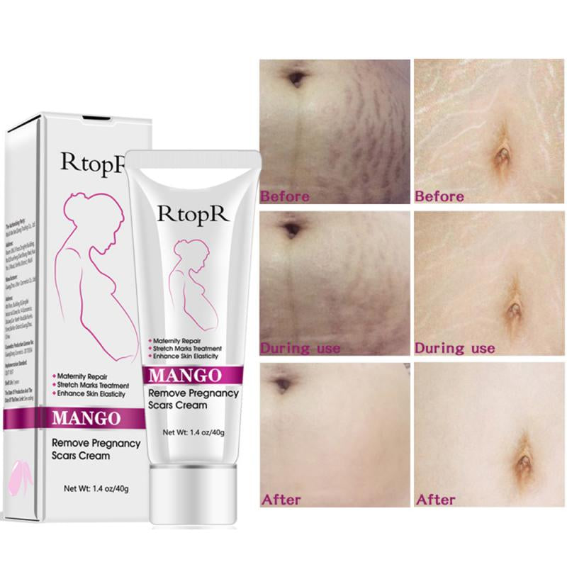Mango Stretch Marks and Scar Cream, Stretch Mark and Scar Removal Cream for Pregnancy, Belly Creams for Wrinkles, Obesity Fat Marks Scars Moisturizing, Remove Marks (40G)