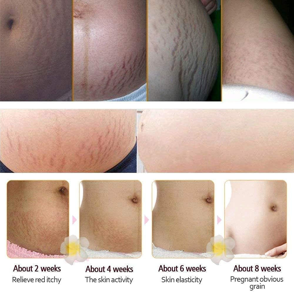 Rtopr Mango Stretch Marks and Scar Cream -Stretch Marks and Scar Removal Cream for Pregnancy - Best Body Moisturizer-40G