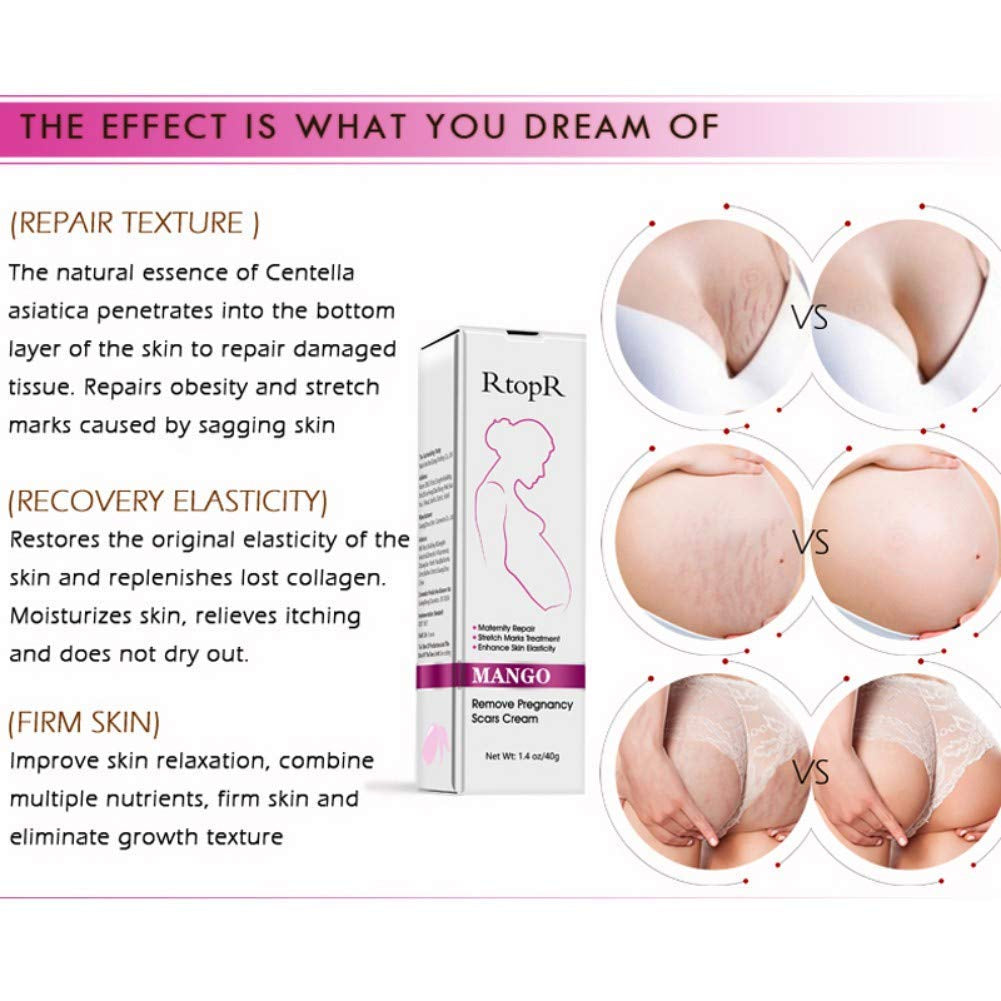 Mango Stretch Marks and Scar Cream, Stretch Mark and Scar Removal Cream for Pregnancy, Belly Creams for Wrinkles, Obesity Fat Marks Scars Moisturizing, Remove Marks (40G)