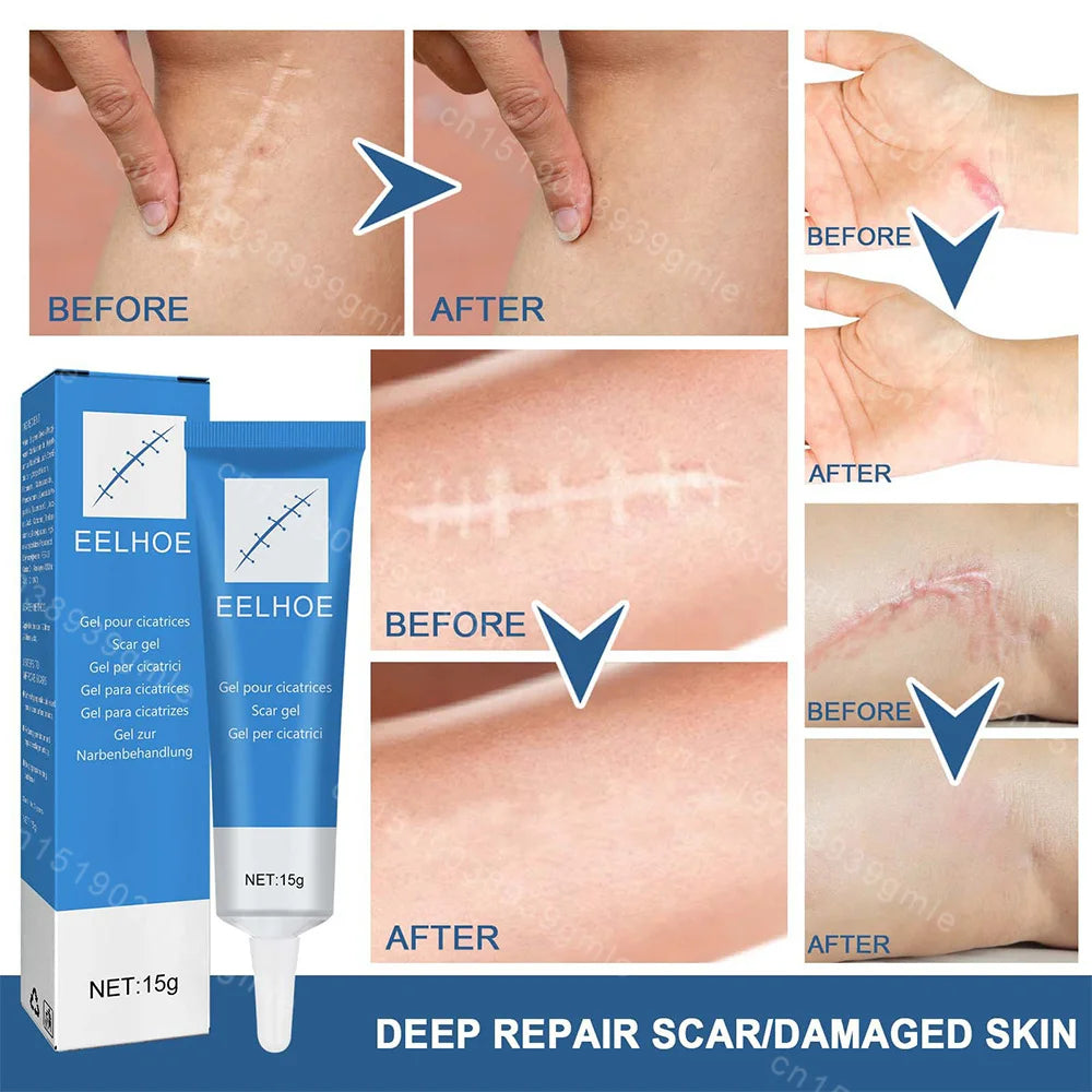 15G Recovery Scar Cream Fast Removal Skin Scars Treat Surgery Scars Stretch Marks Acne Pox Prints Burn Repair Facial Care Gel